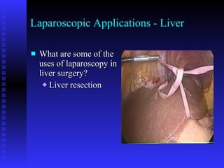 Laparoscopic Applications - Liver What are some of the uses of laparoscopy in liver surgery? Liver resection 