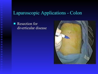Laparoscopic Applications - Colon Resection for diverticular disease 