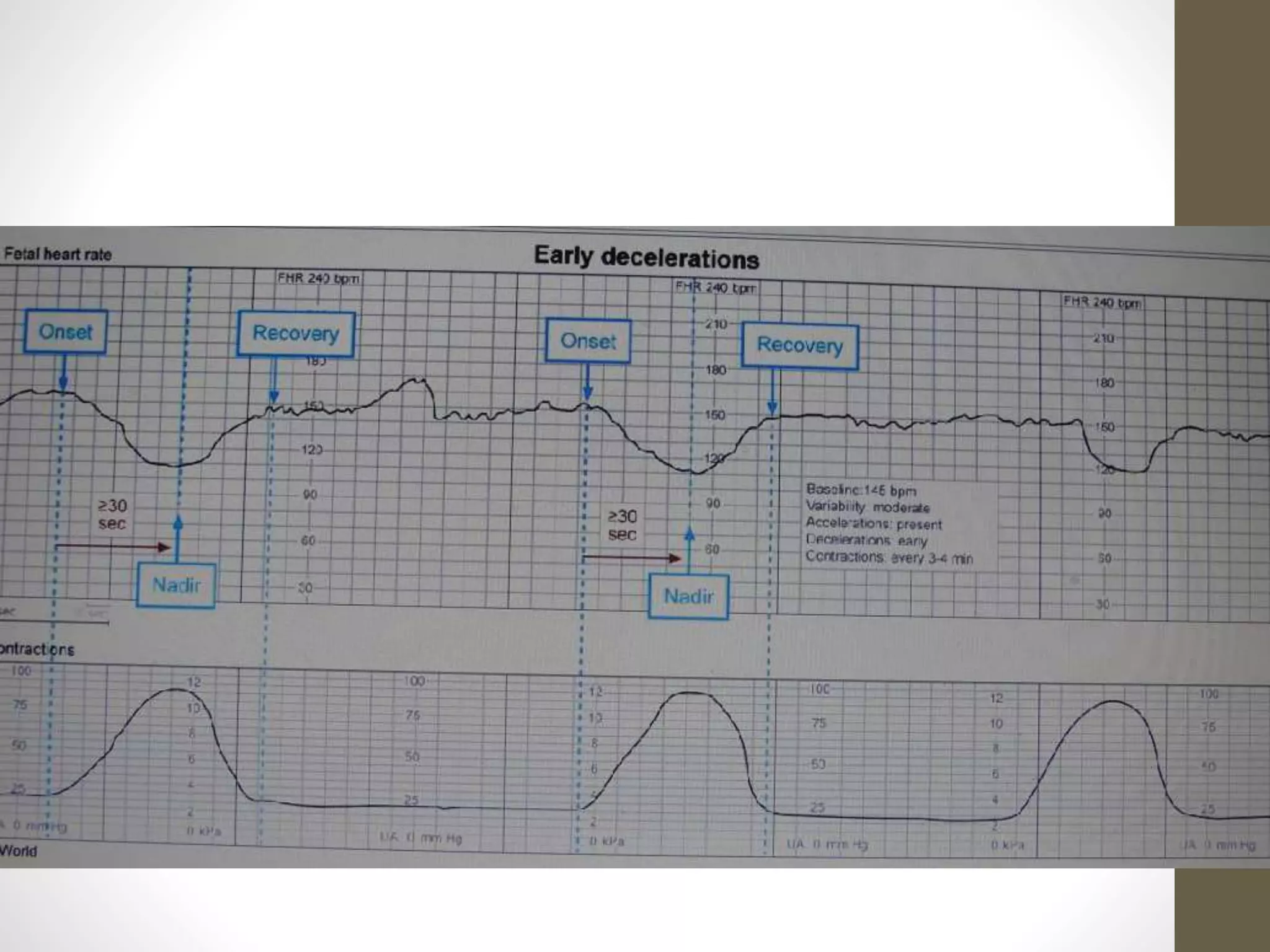 Evaluating of fetal heart tracing