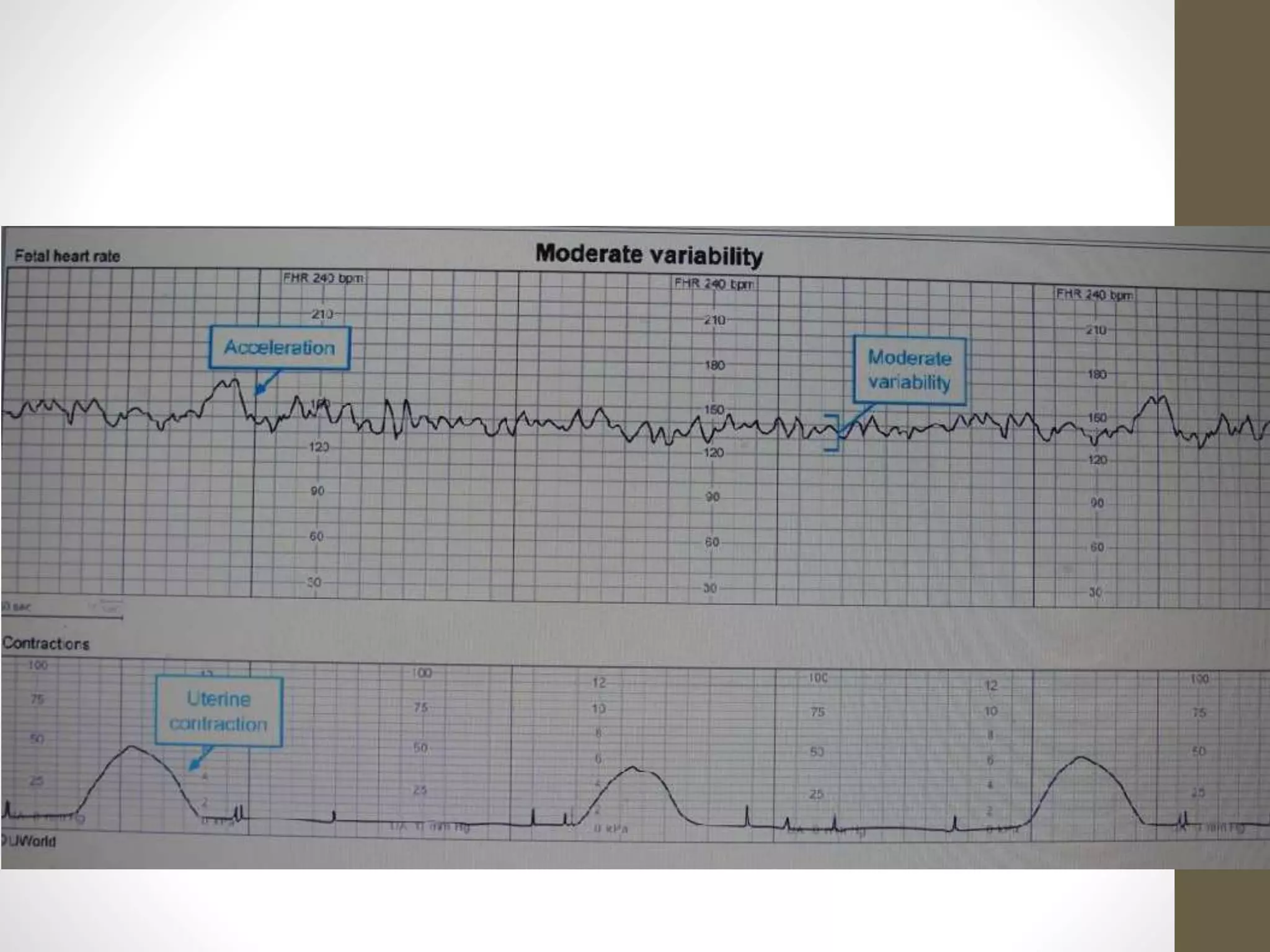 Evaluating of fetal heart tracing