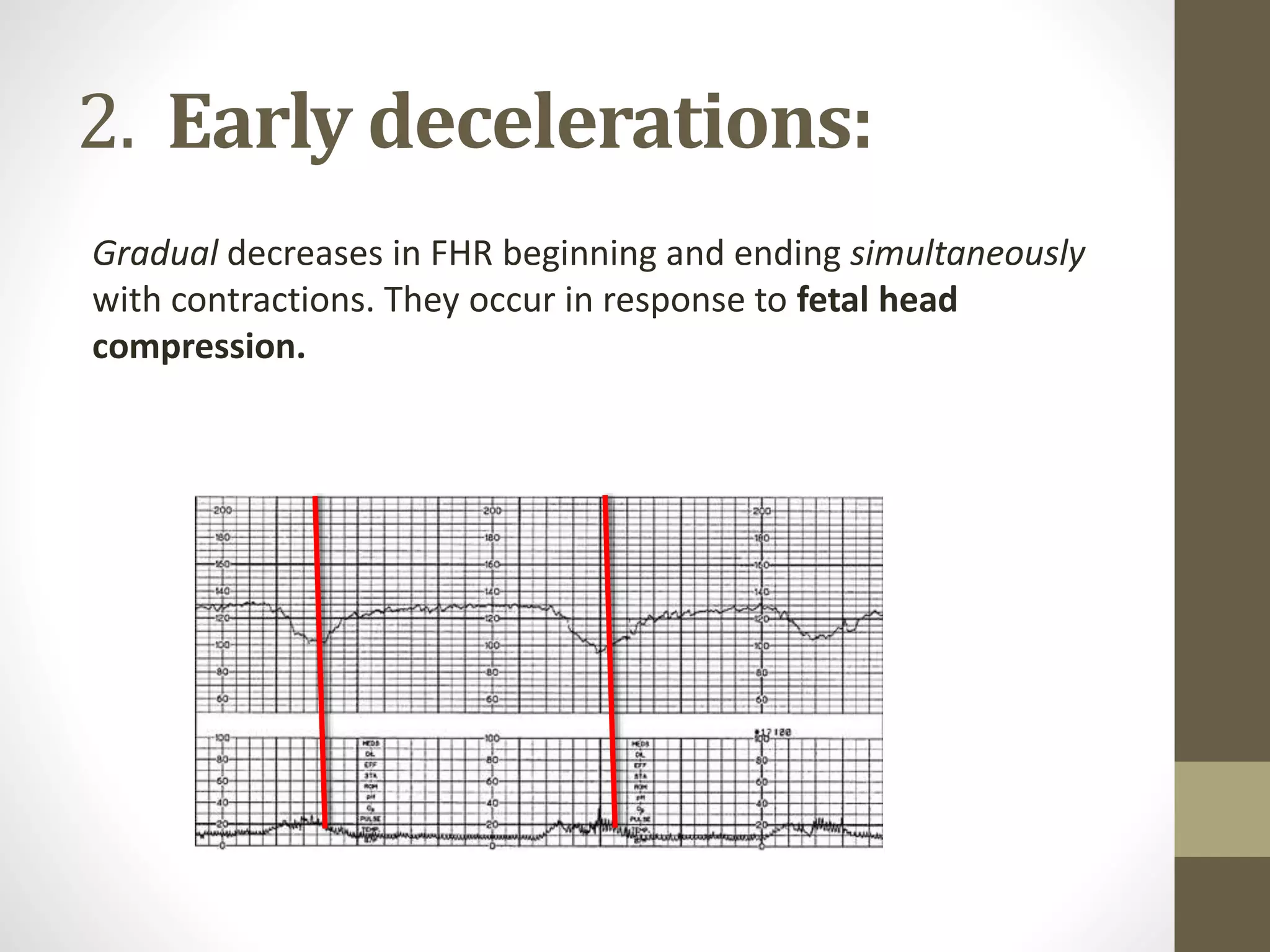 2. Early decelerations:
Gradual decreases in FHR beginning and ending simultaneously
with contractions. They occur in response to fetal head
compression.
 