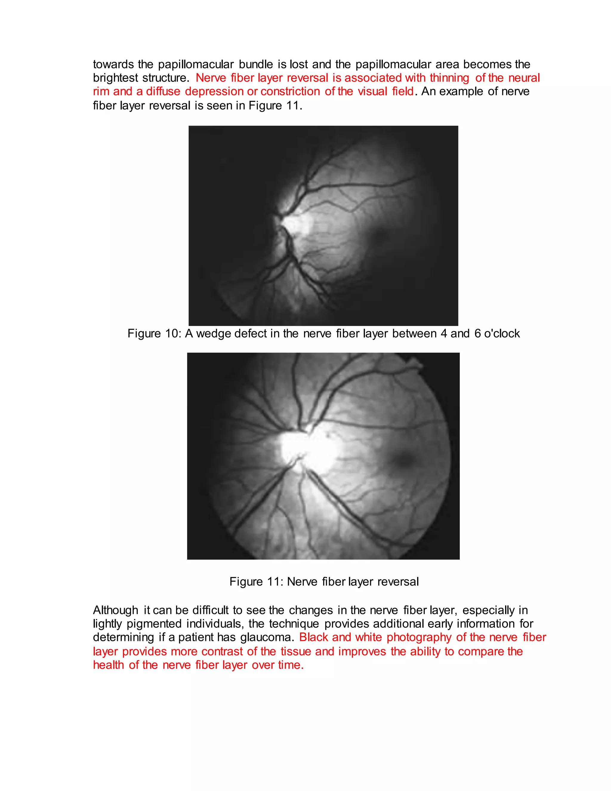 Evaluating the optic nerve head in glaucoma