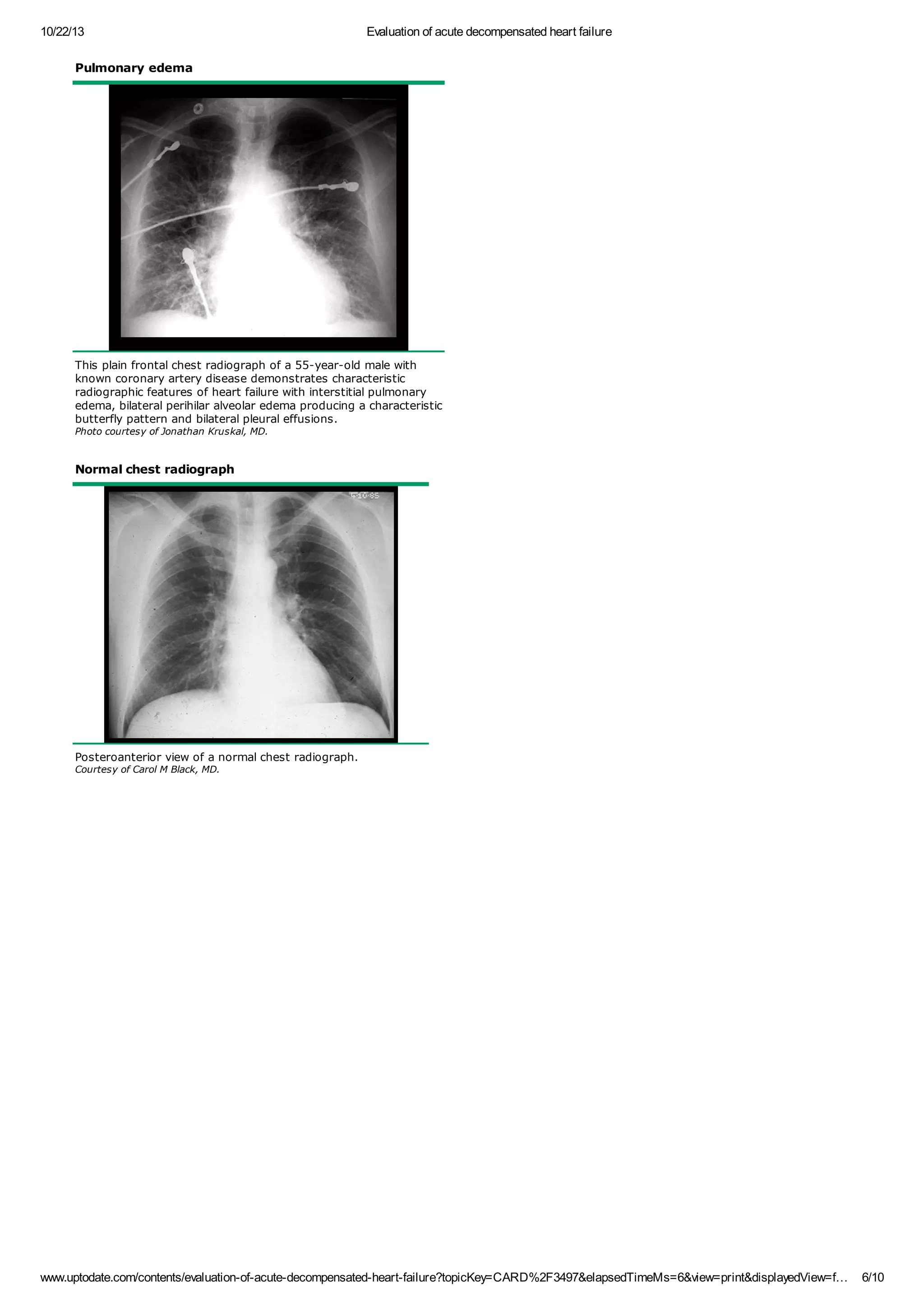 Evaluation of acute decompensated heart failure | PDF