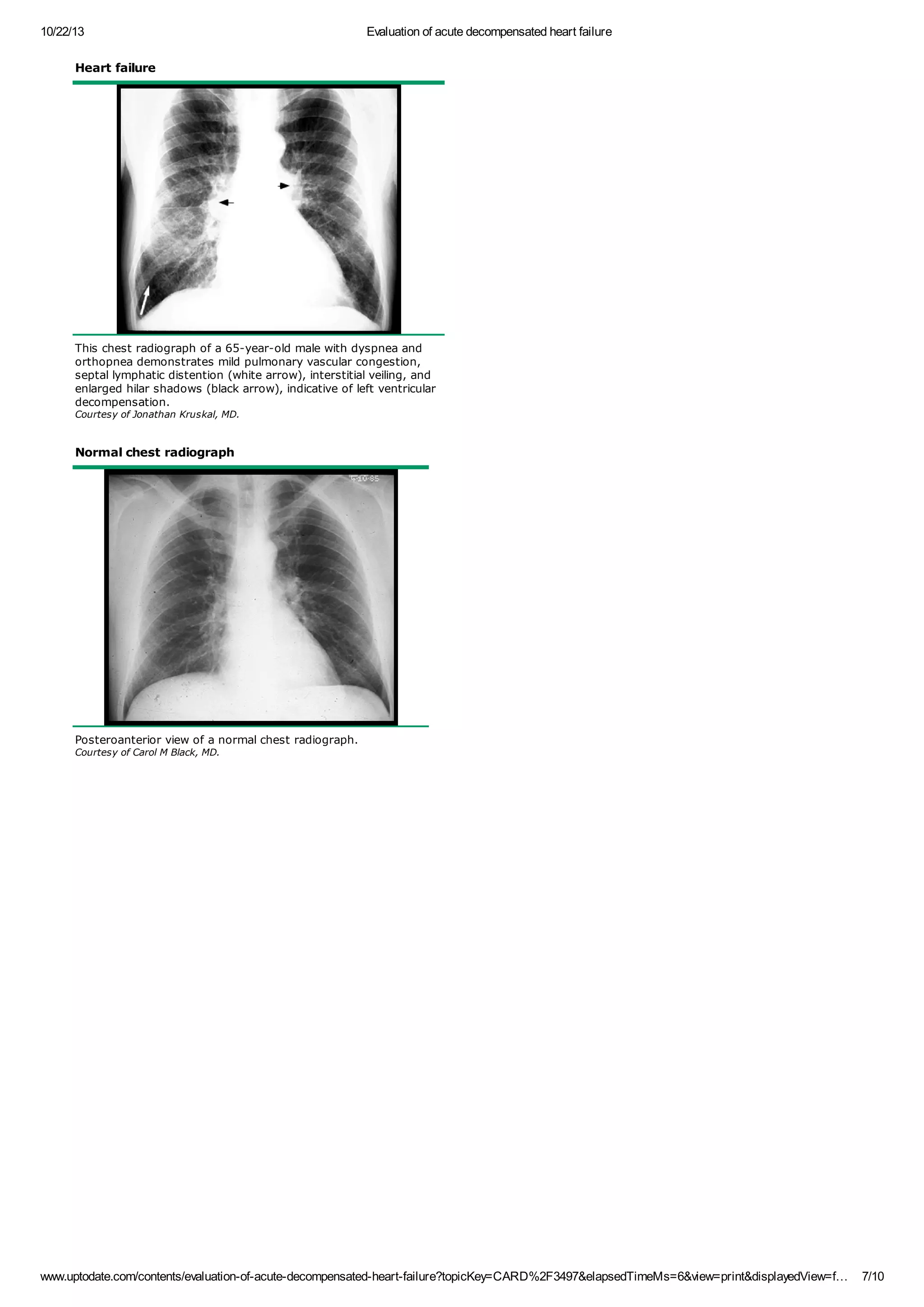 Evaluation of acute decompensated heart failure | PDF