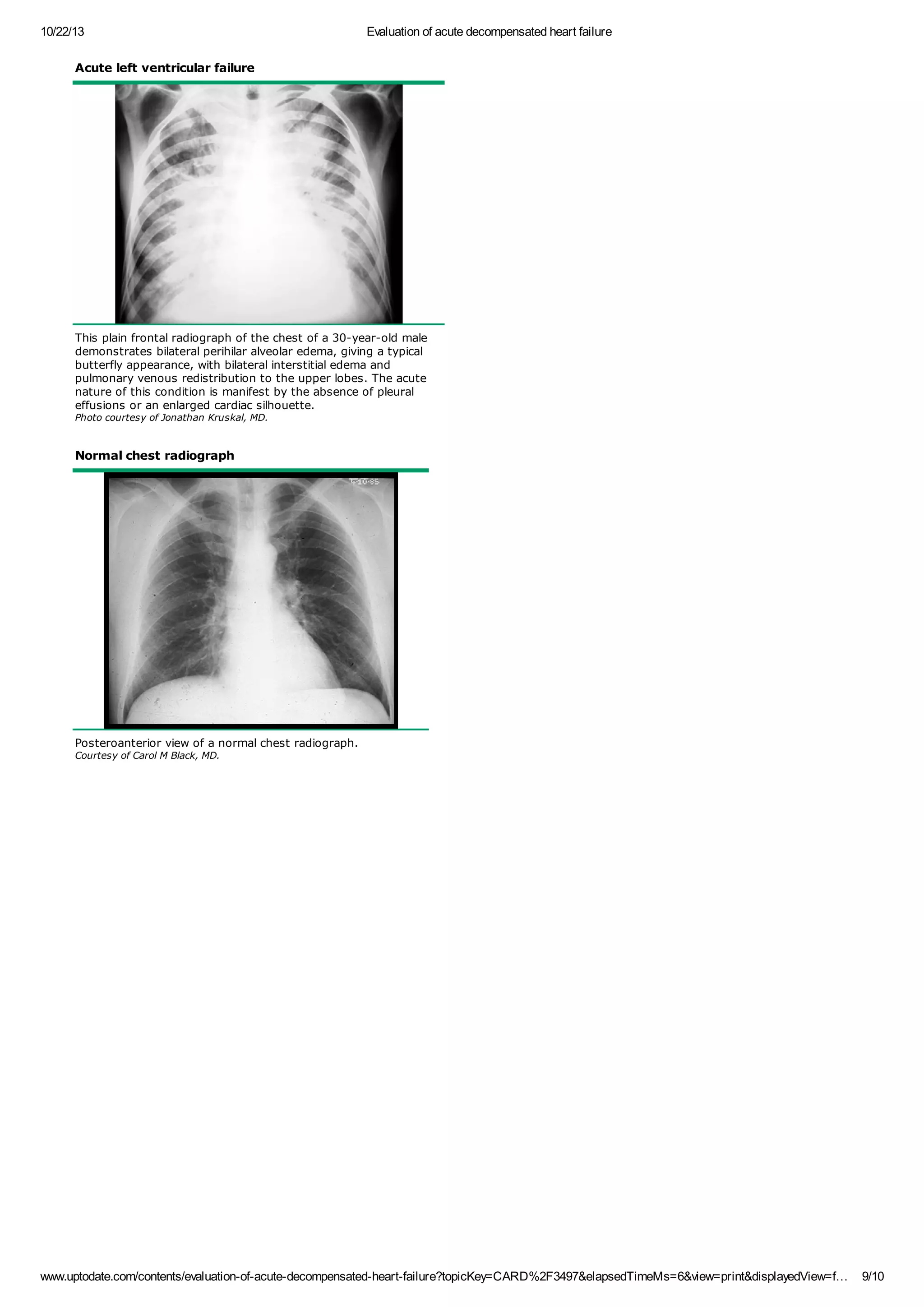 Evaluation of acute decompensated heart failure | PDF