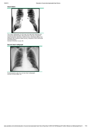 Evaluation of acute decompensated heart failure | PDF