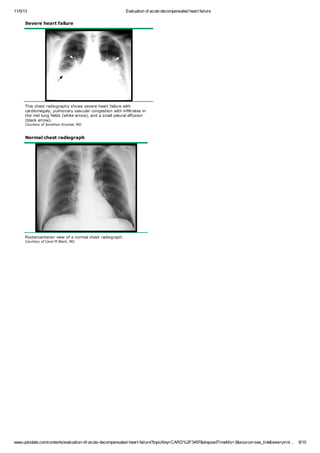 Evaluation of acute decompensated heart failure2 | PDF