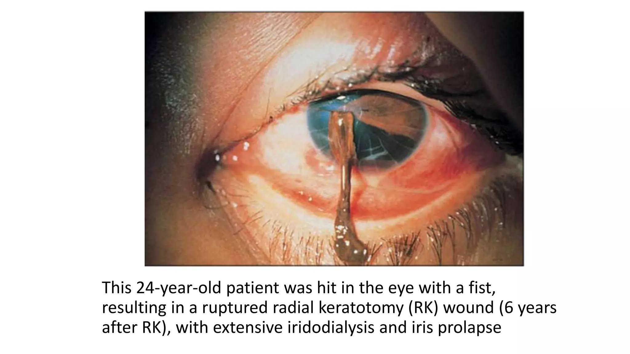 This 24-year-old patient was hit in the eye with a fist,
resulting in a ruptured radial keratotomy (RK) wound (6 years
after RK), with extensive iridodialysis and iris prolapse
 