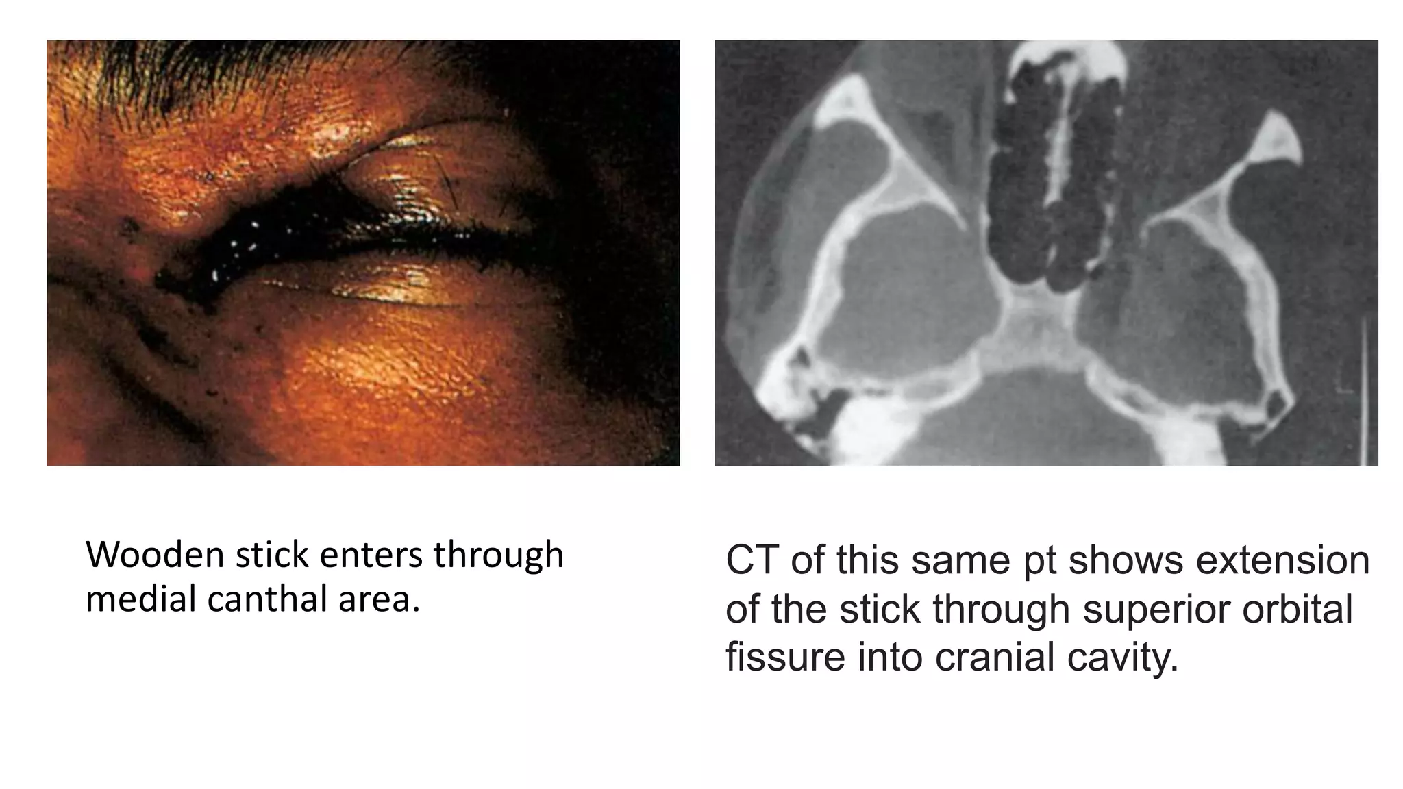 Wooden stick enters through
medial canthal area.
CT of this same pt shows extension
of the stick through superior orbital
fissure into cranial cavity.
 