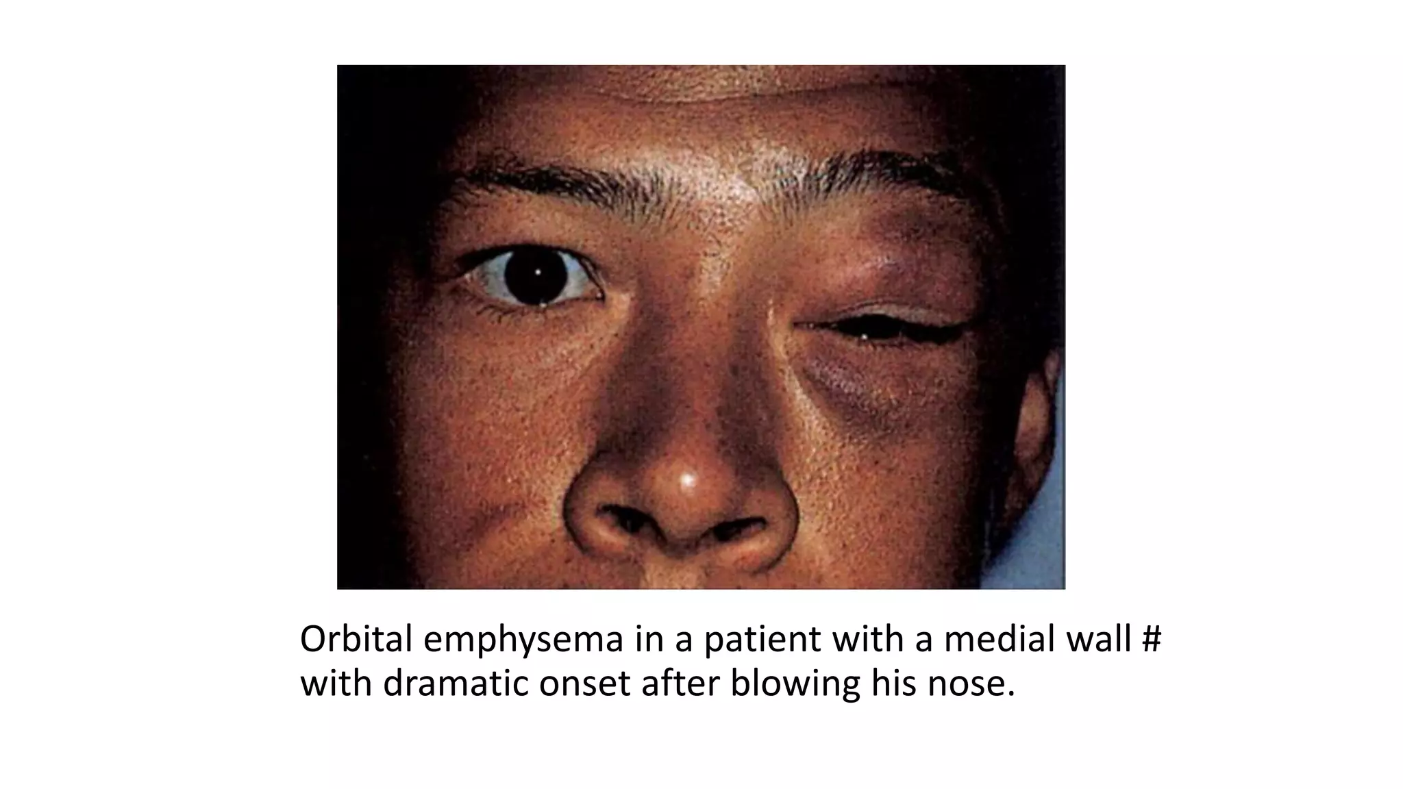 Orbital emphysema in a patient with a medial wall #
with dramatic onset after blowing his nose.
 