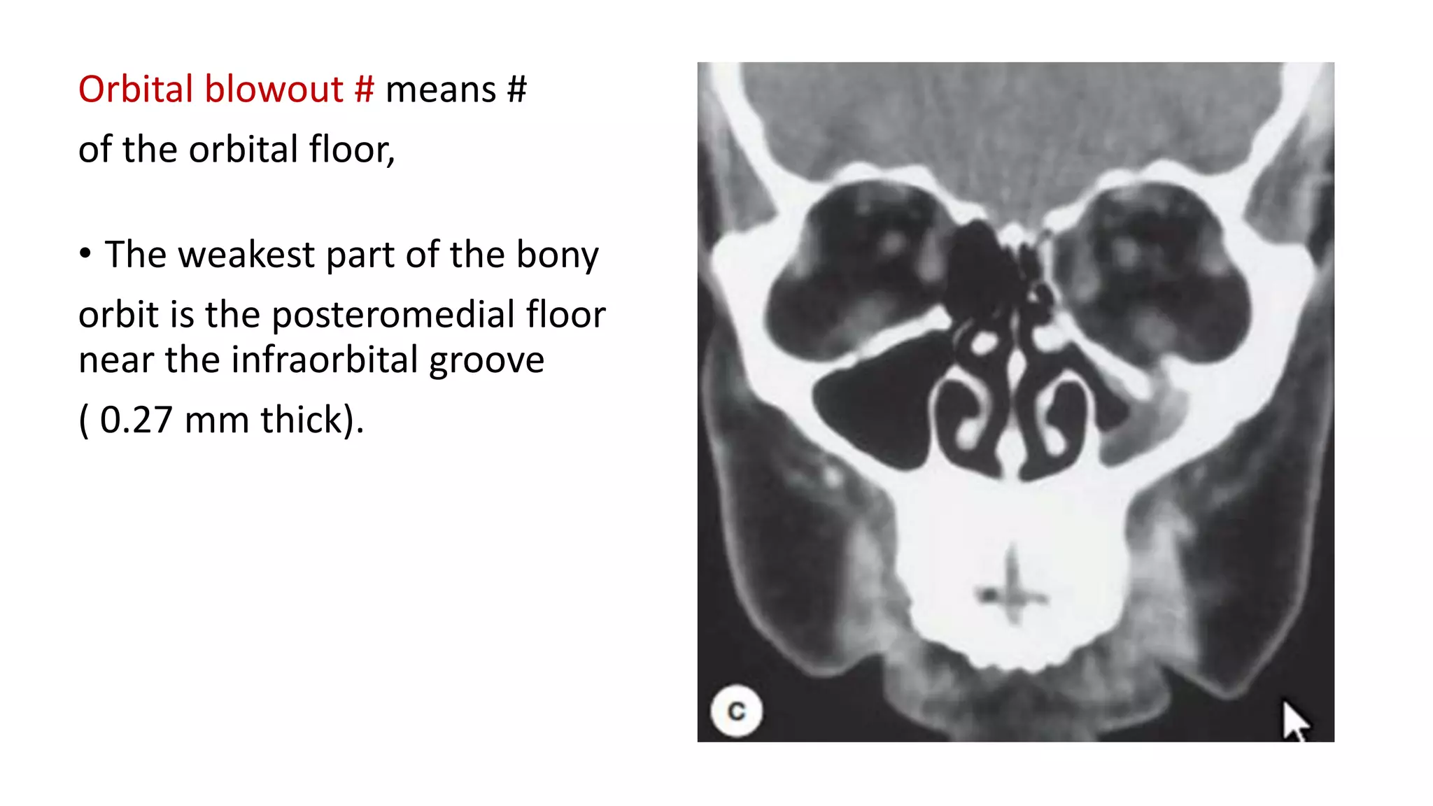 Orbital blowout # means #
of the orbital floor,
• The weakest part of the bony
orbit is the posteromedial floor
near the infraorbital groove
( 0.27 mm thick).
 