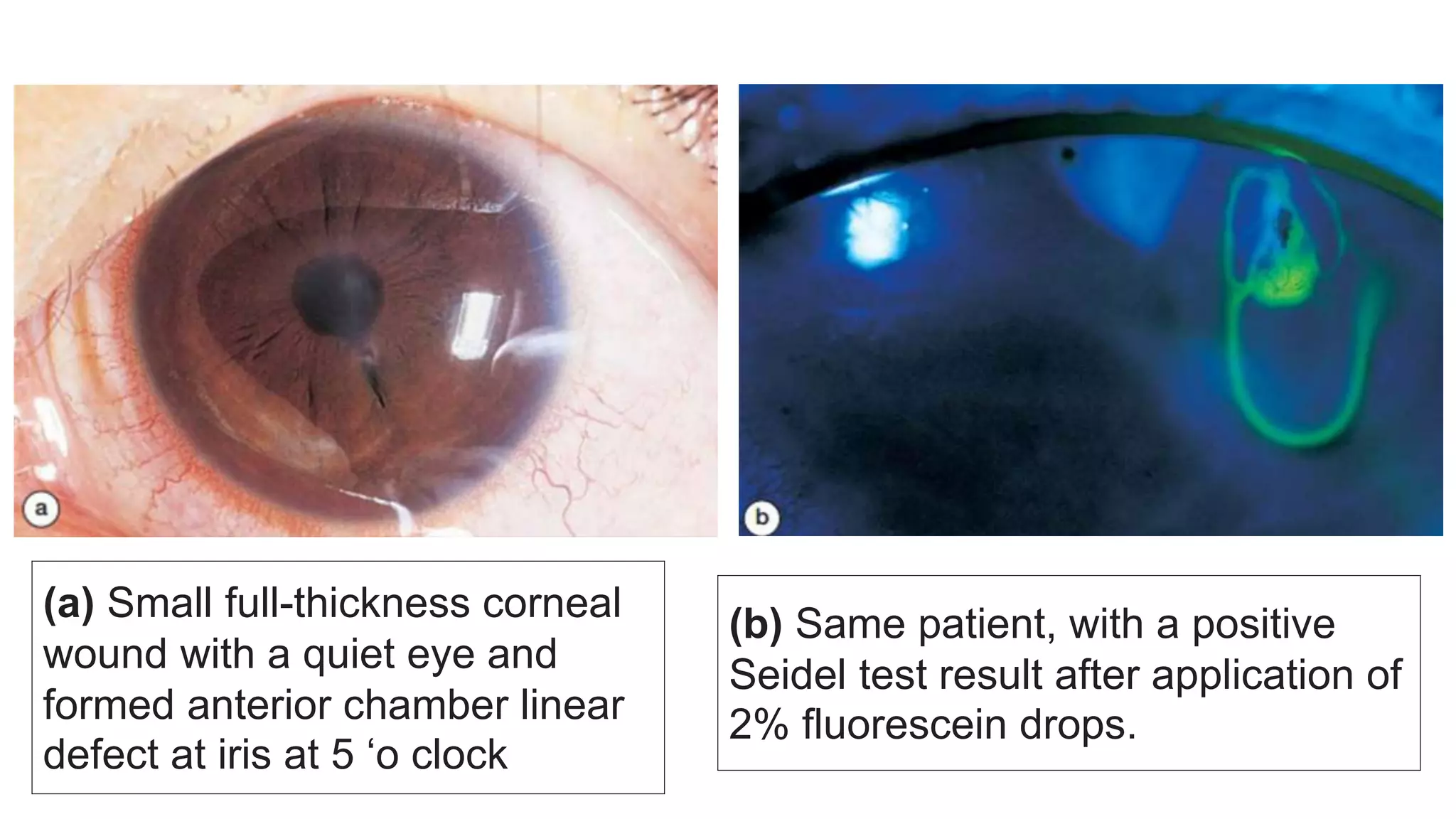 •
(a) Small full-thickness corneal
wound with a quiet eye and
formed anterior chamber linear
defect at iris at 5 ‘o clock
(b) Same patient, with a positive
Seidel test result after application of
2% fluorescein drops.
 
