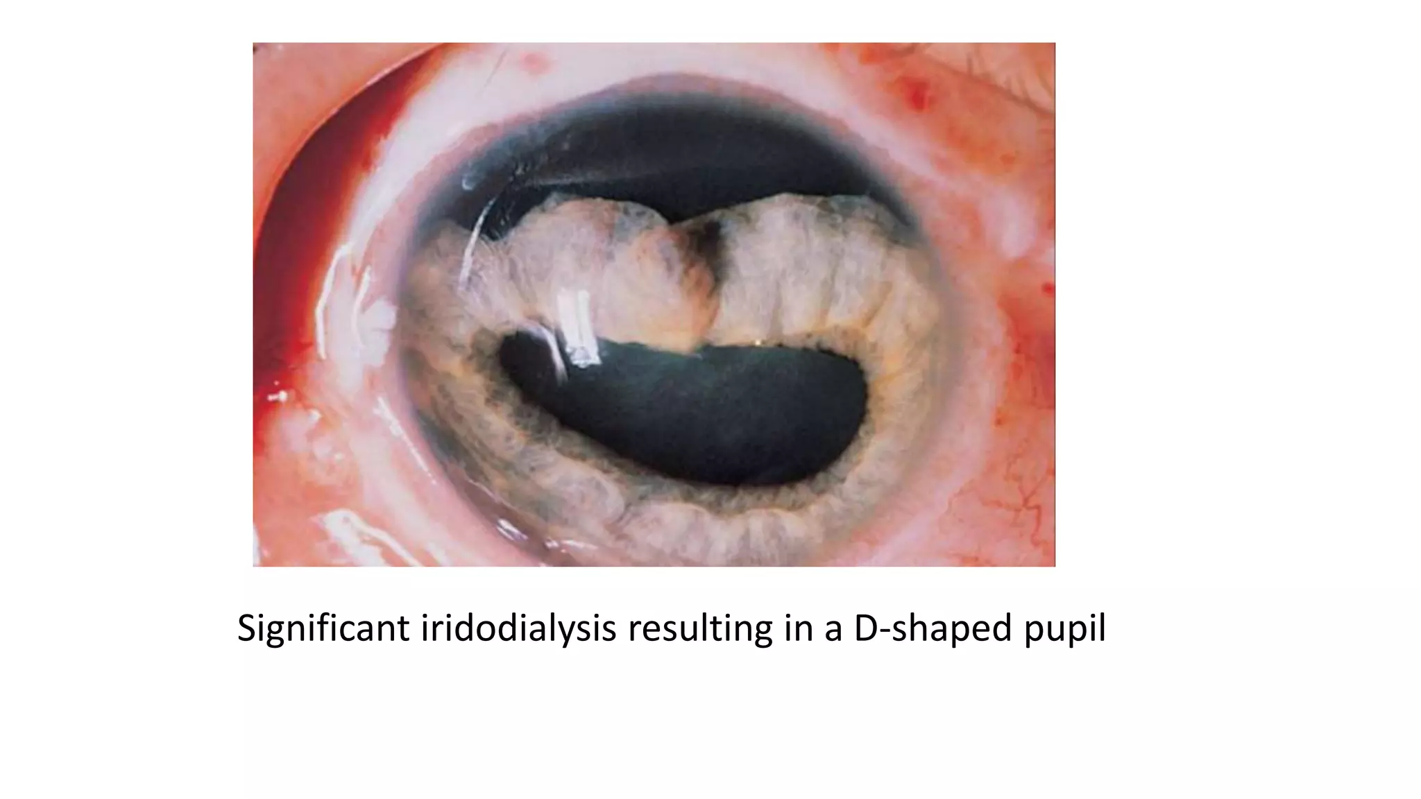 Significant iridodialysis resulting in a D-shaped pupil
 
