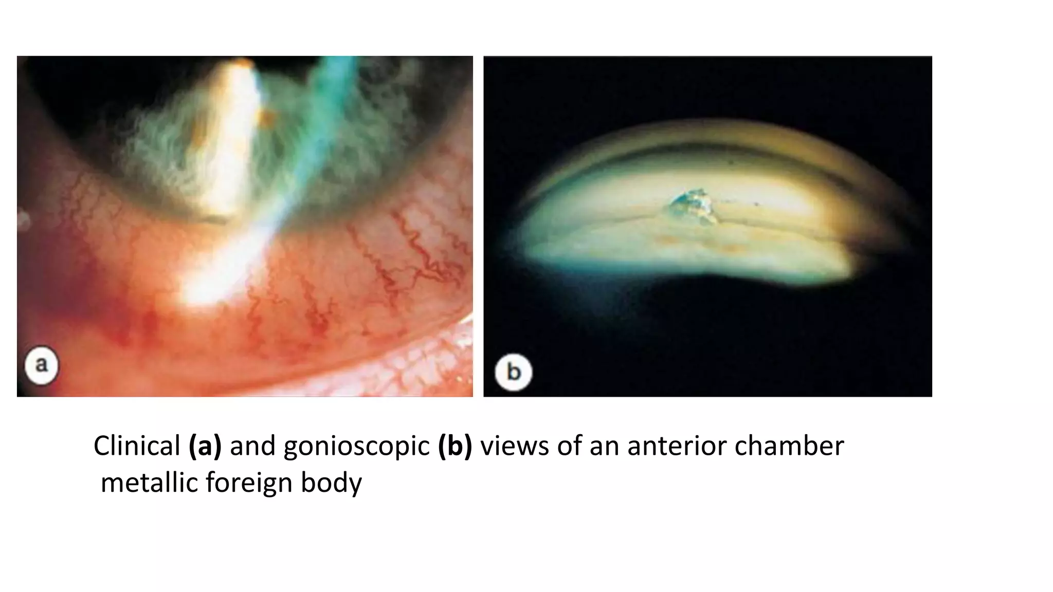 Clinical (a) and gonioscopic (b) views of an anterior chamber
metallic foreign body
 