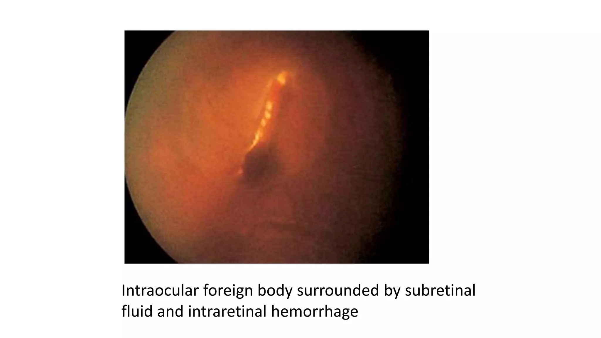 Intraocular foreign body surrounded by subretinal
fluid and intraretinal hemorrhage
 
