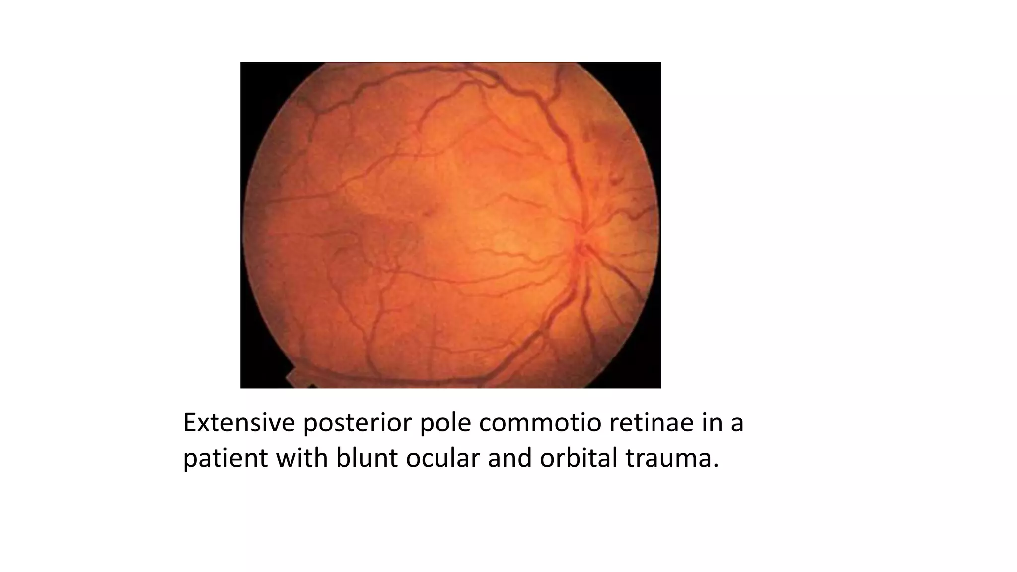 Extensive posterior pole commotio retinae in a
patient with blunt ocular and orbital trauma.
 