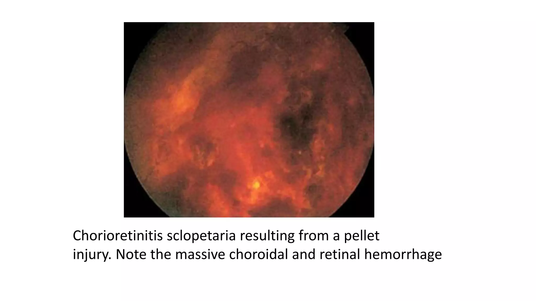 Chorioretinitis sclopetaria resulting from a pellet
injury. Note the massive choroidal and retinal hemorrhage
 