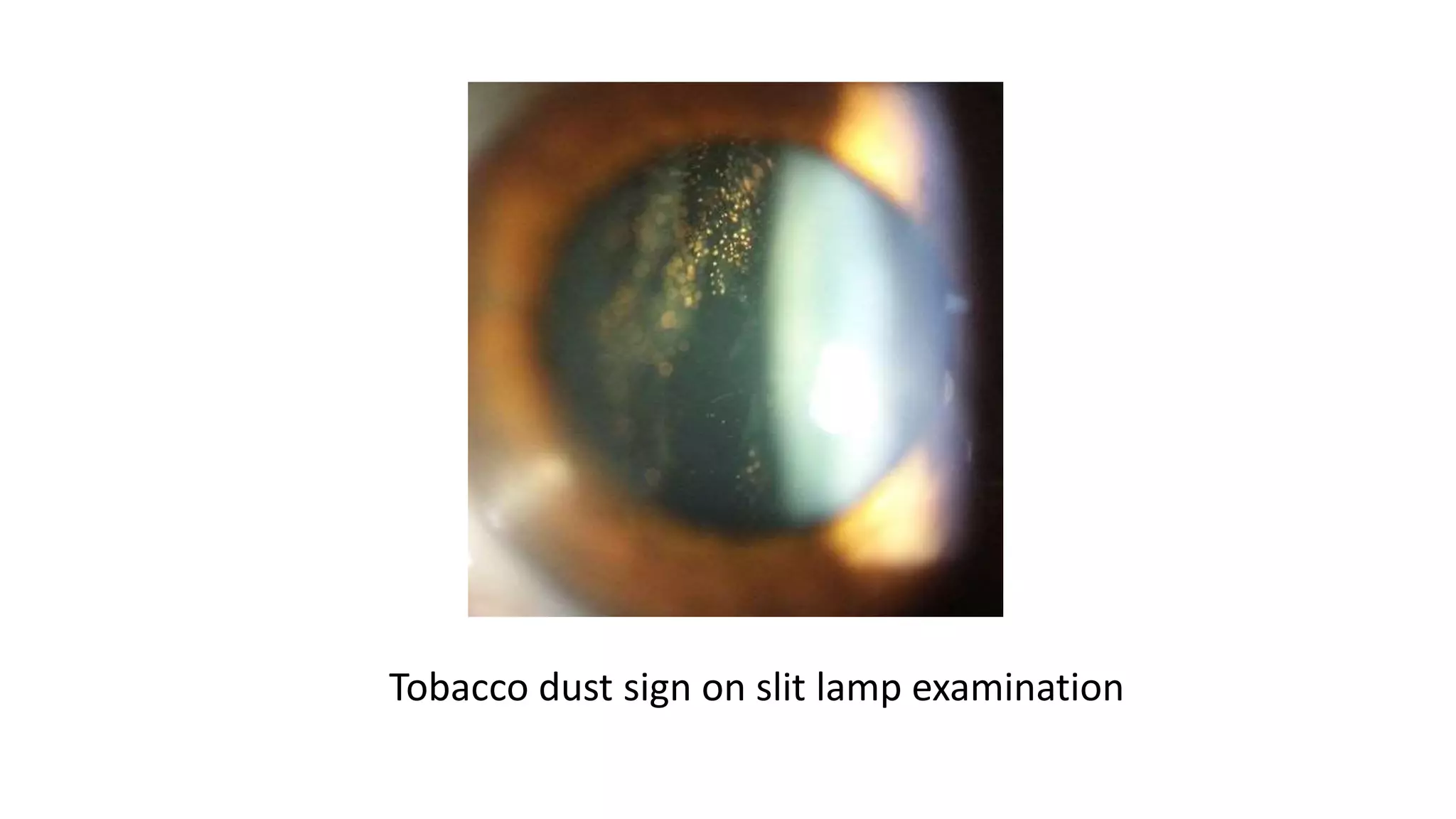 Tobacco dust sign on slit lamp examination
 