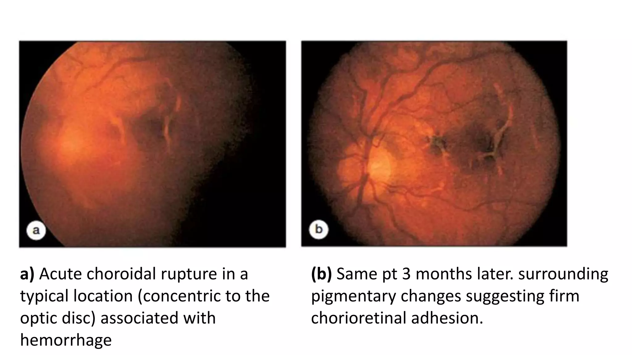 a) Acute choroidal rupture in a
typical location (concentric to the
optic disc) associated with
hemorrhage
(b) Same pt 3 months later. surrounding
pigmentary changes suggesting firm
chorioretinal adhesion.
 