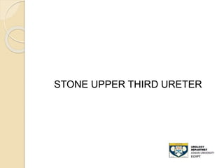 STONE UPPER THIRD URETER
 