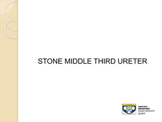 STONE MIDDLE THIRD URETER
 