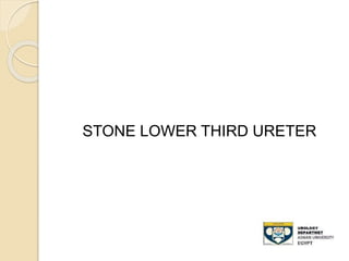 STONE LOWER THIRD URETER
 