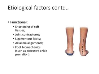 Etiological factors contd..
• Functional:
• Shortening of soft
tissues;
• Joint contractures;
• Ligamentous laxity;
• Axial malalignments;
• Foot biomechanics
(such as excessive ankle
pronation).
 