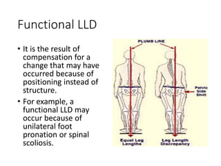 Functional LLD
• It is the result of
compensation for a
change that may have
occurred because of
positioning instead of
structure.
• For example, a
functional LLD may
occur because of
unilateral foot
pronation or spinal
scoliosis.
 