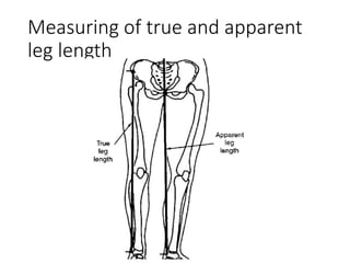 Measuring of true and apparent
leg length
 
