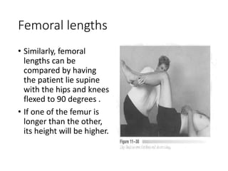 Femoral lengths
• Similarly, femoral
lengths can be
compared by having
the patient lie supine
with the hips and knees
flexed to 90 degrees .
• If one of the femur is
longer than the other,
its height will be higher.
 