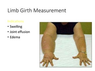 Limb Girth Measurement
Indications
• Swelling
• Joint effusion
• Edema
 