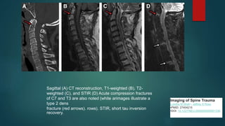 Evaluation of acute trauma in spine | PPTX