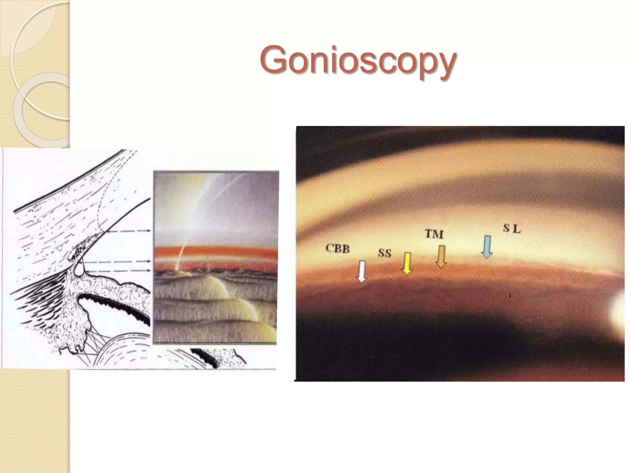 Gonioscopy
 