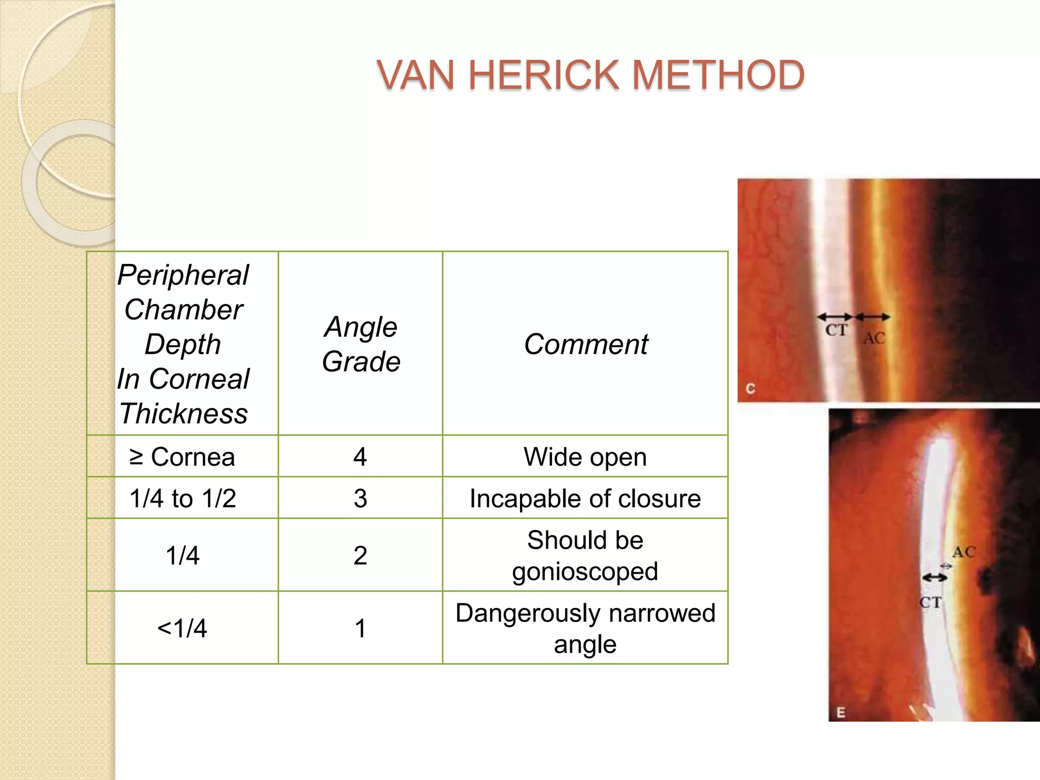VAN HERICK METHOD
Peripheral
Chamber
Depth
In Corneal
Thickness
Angle
Grade
Comment
≥ Cornea 4 Wide open
1/4 to 1/2 3 Incapable of closure
1/4 2
Should be
gonioscoped
<1/4 1
Dangerously narrowed
angle
 