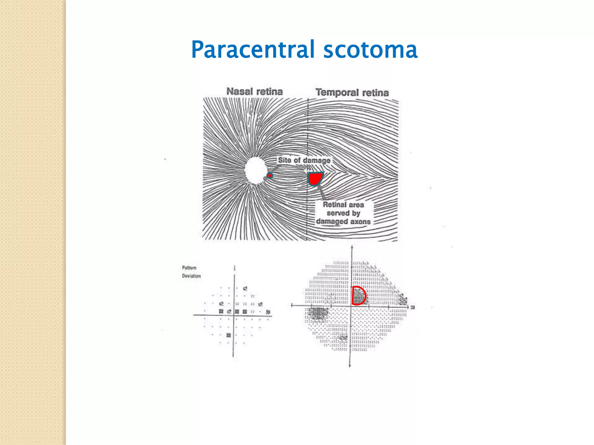 Paracentral scotoma
 
