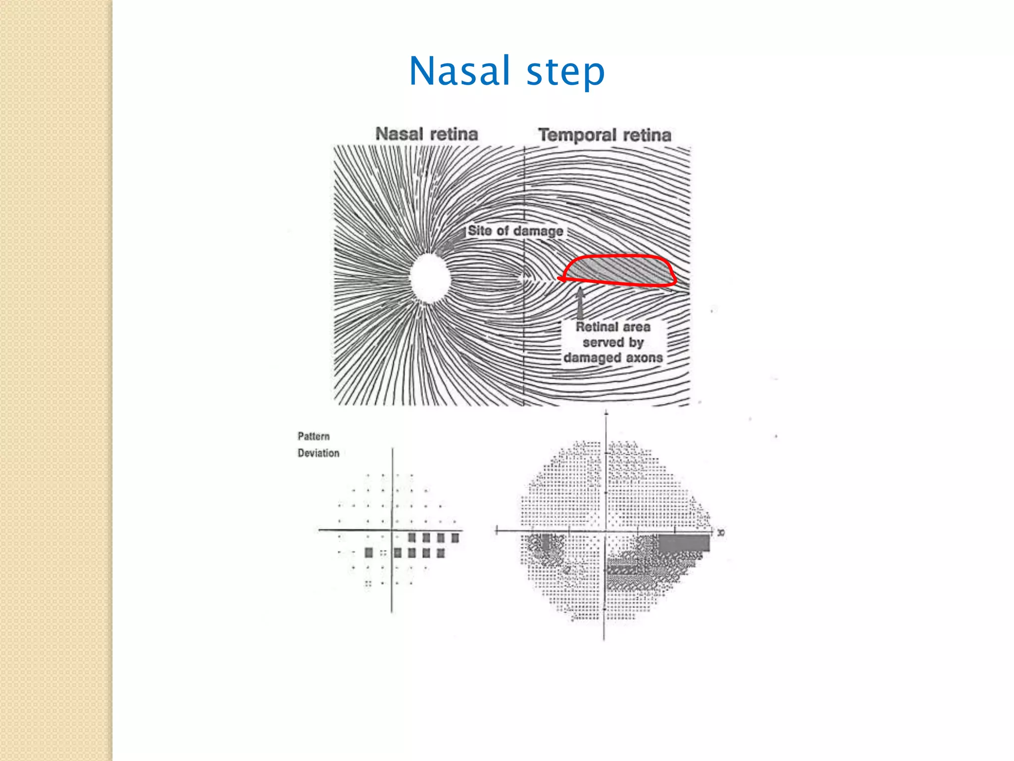 Nasal step
 