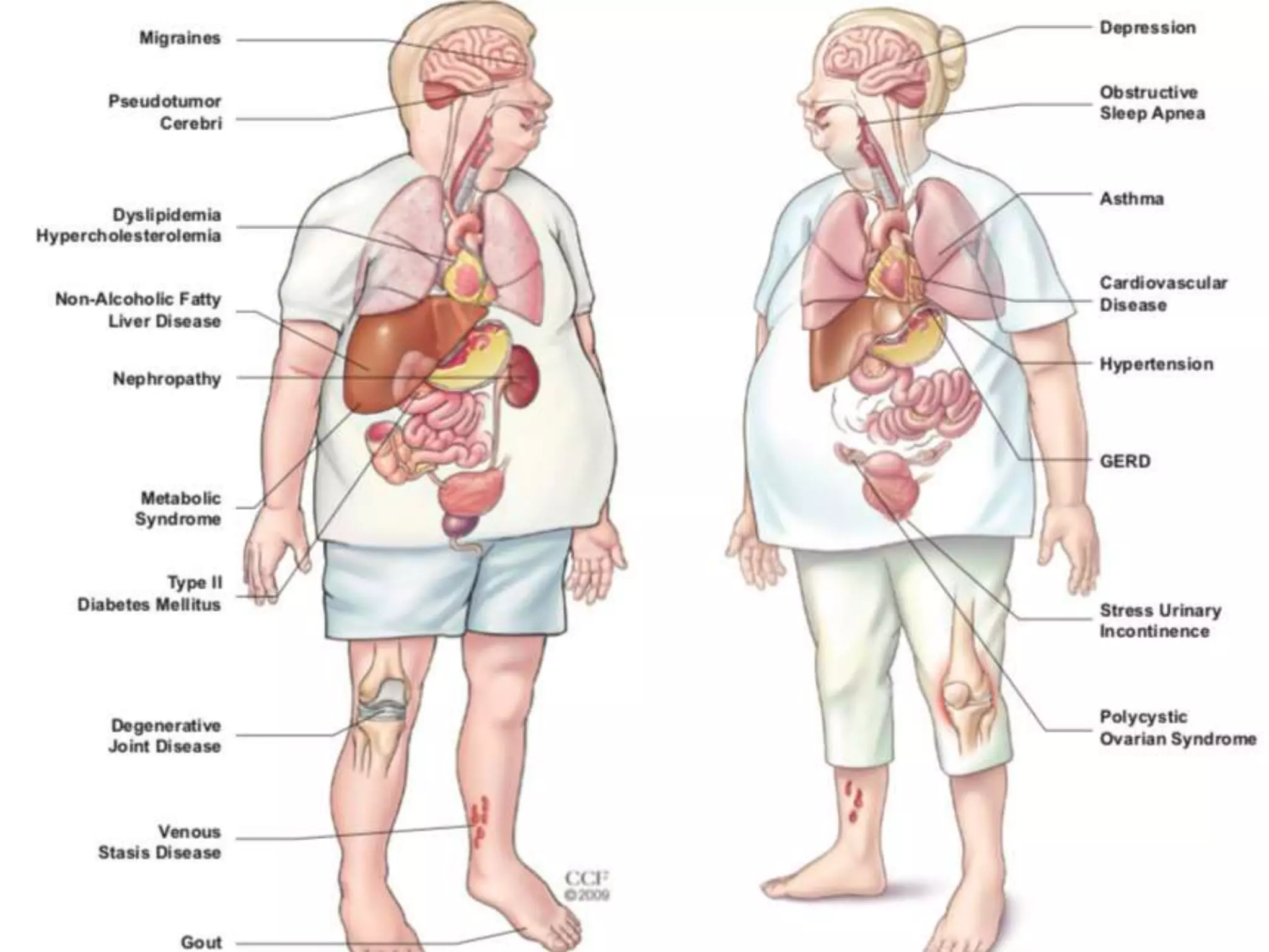 Risk of comorbidities
 