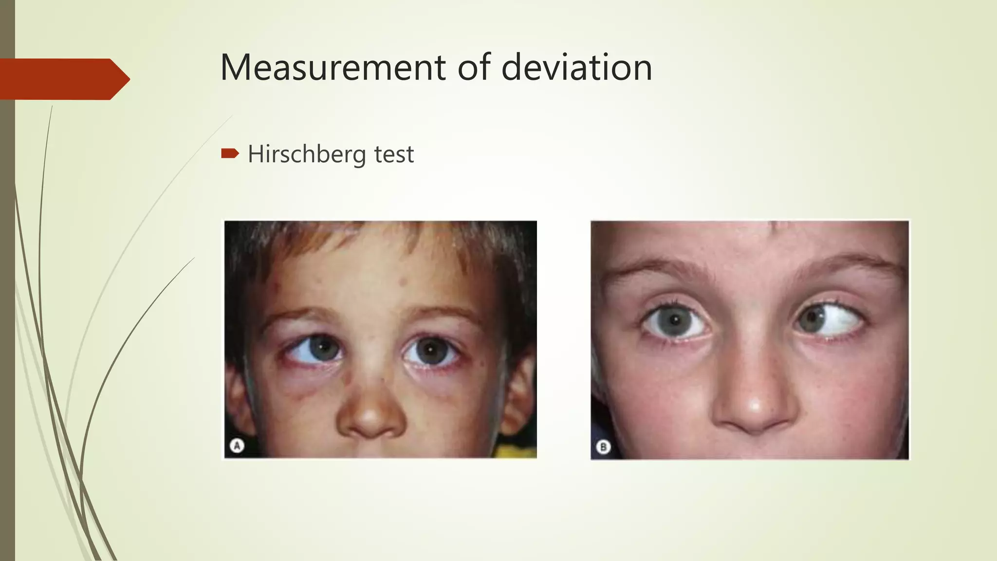Hirschberg Test Normal Evaluation of a patient with diplopia | PPTX