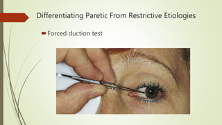 Evaluation of a patient with diplopia | PPTX