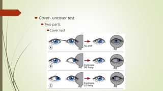Evaluation of a patient with diplopia | PPTX