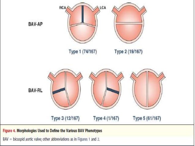 Echocardiographic Evaluation Of Aortic Stenosis