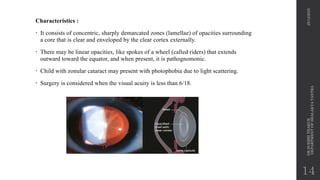 EVALUATION OF CATARACT BY DR. SURBHI THAKUR .pptx
