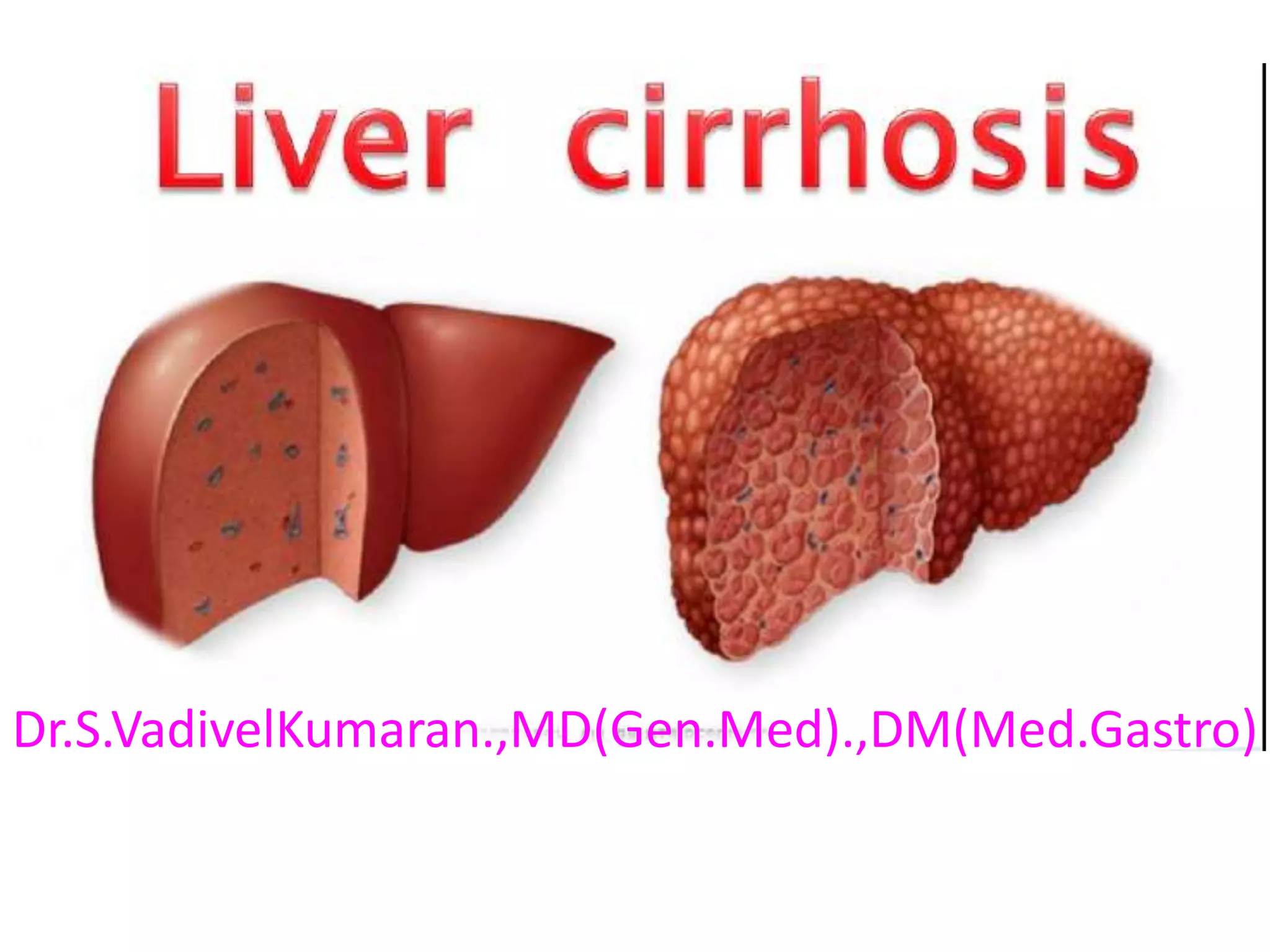 Dr.S.VadivelKumaran.,MD(Gen.Med).,DM(Med.Gastro)