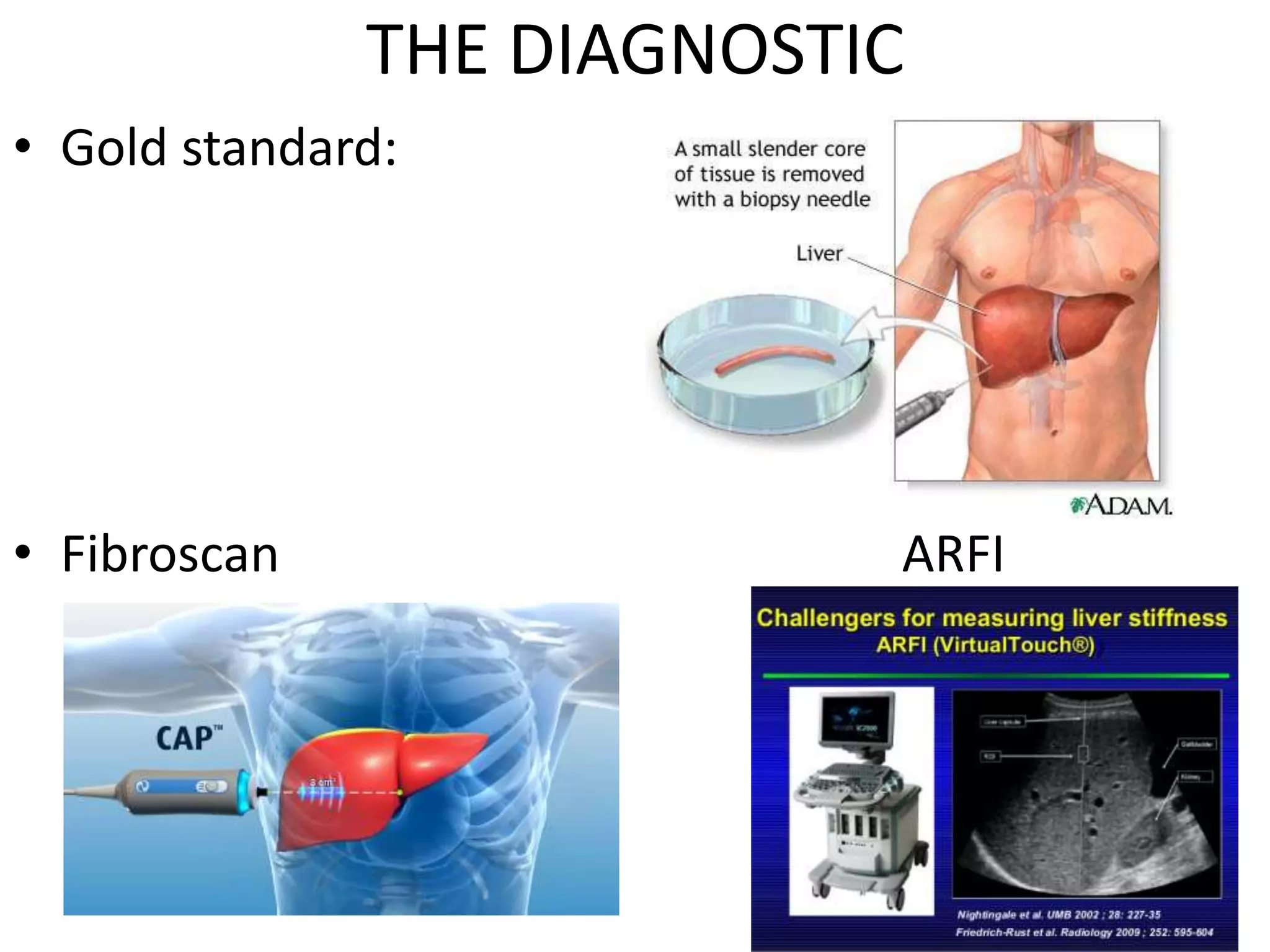 THE DIAGNOSTIC
• Gold standard:
• Fibroscan ARFI