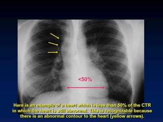 Evaluation of congenital heart disease | PPTX