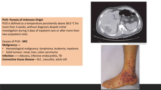 PUO- Pyrexia of Unknown Origin
PUO is defined as a temperature persistently above 38.0 °C for
more than 3 weeks, without diagnosis despite initial
investigation during 3 days of inpatient care or after more than
two outpatient visits
Causes of PUO : MIC
Malignancy----
• Hematological malignancy :lymphoma, leukemia, myeloma
• Solid tumour: renal, liver, colon carcinoma
Infection-------Abscess, infective endocarditis, TB
Connective tissue disease—SLE , vasculitis, adult still
 