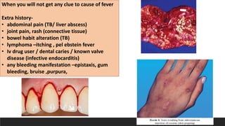 When you will not get any clue to cause of fever
Extra history-
• abdominal pain (TB/ liver abscess)
• joint pain, rash (connective tissue)
• bowel habit alteration (TB)
• lymphoma –itching , pel ebstein fever
• Iv drug user / dental caries / known valve
disease (infective endocarditis)
• any bleeding manifestation –epistaxis, gum
bleeding, bruise ,purpura,
 