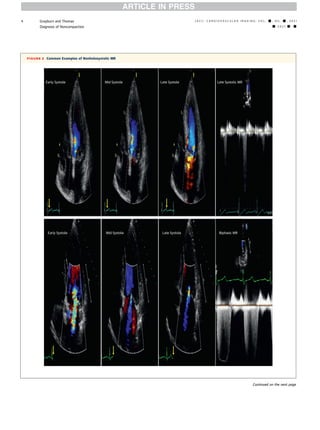 Evaluation of mitral regurgitation | PDF