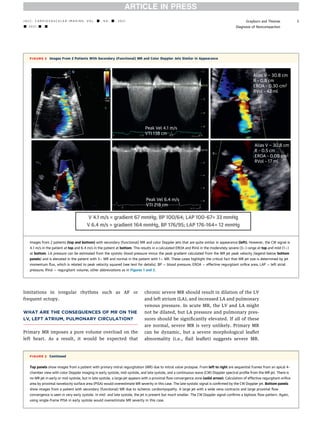Evaluation of mitral regurgitation | PDF