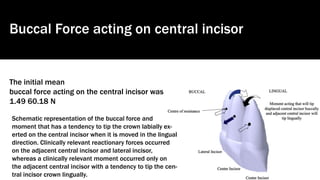 Schematic representation of the buccal force and
moment that has a tendency to tip the crown labially ex-
erted on the central incisor when it is moved in the lingual
direction. Clinically relevant reactionary forces occurred
on the adjacent central incisor and lateral incisor,
whereas a clinically relevant moment occurred only on
the adjacent central incisor with a tendency to tip the cen-
tral incisor crown lingually.
Buccal Force acting on central incisor
The initial mean
buccal force acting on the central incisor was
1.49 60.18 N
 